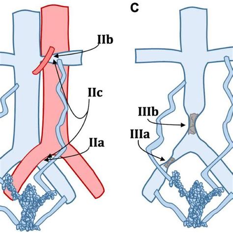 Proposed Management Oriented Classification Of Pelvic Venous Disorders