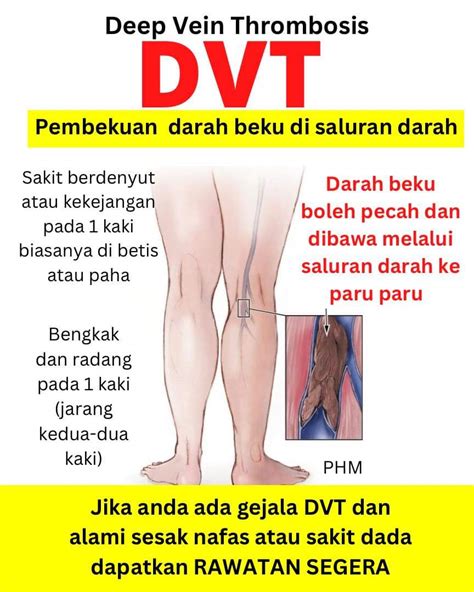 Public Health Malaysia On Twitter DVT Merupakan Pembentukan Darah