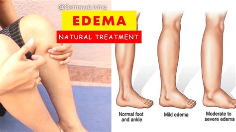 Swelling In Legs Feet Ankle Home Remedies Treat Edema Lower Limbs