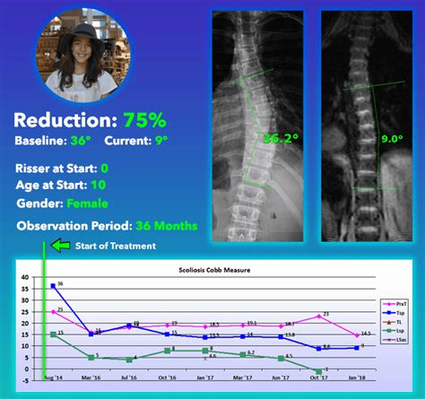 Non Surgical Scoliosis Treatment Results Scoliosis Care Centers