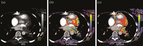 A Year Old Woman With Histologically Proven Recurrent Leiomyosarcoma