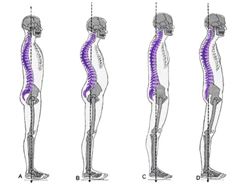 Posture Faqs Kewin Chiropractic