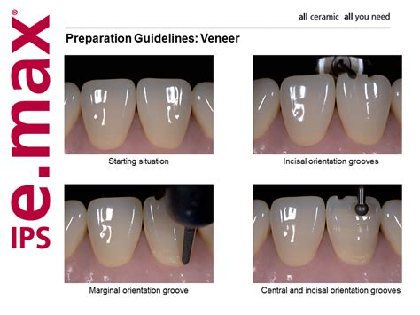 emax veneers preparation  jerry fagan blog
