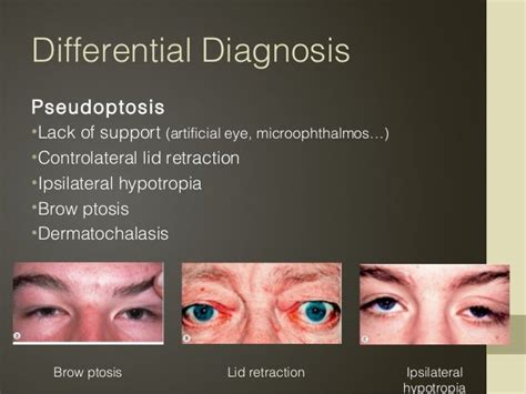 Upper Lid Ptosis