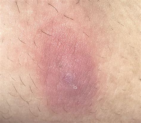 What Could This Be Its A Bump On My Inner Thigh Thats Warm When You Touch It Rskin