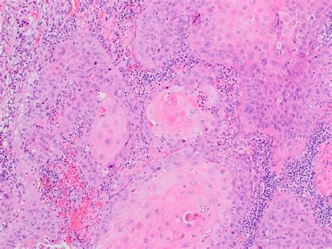 Squamous Cell Carcinoma Lung Keratin Pearls