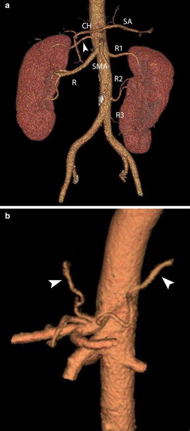 3D Volume Rendering Technique VRT Images Reconstructed By Arterial