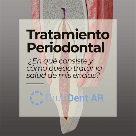 Salud Periodontal Entendiendo La Periodoncia Grup Dent Ar