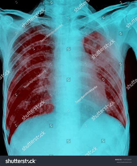 Pulmonary Tuberculosis Film Xray Chest Show Foto Stok 1133722631 Shutterstock