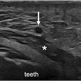 a Transverse 22-8 MHz US image shows the facial artery (white arrow ...