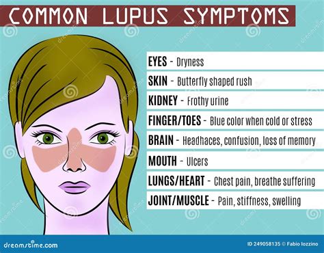 Common Lupus Symptoms. Illustration of Young Woman with Lupus Syndrome ...