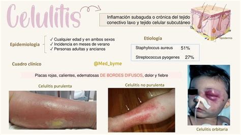 Celulitis Med Byme UDocz