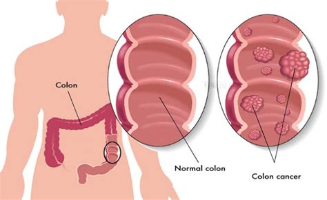 10 Warning Signs Of Colon Cancer You Shouldn’t Ignore 6 Tips To Reduce The Risk