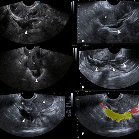 Deep Infiltrating Endometriosis Of The Colorectum Ab Show