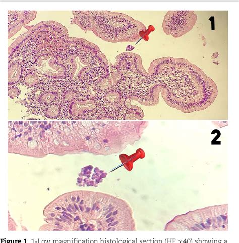 Pdf Gastroenteric Anastomosis In The Setting Of Marked Stomach