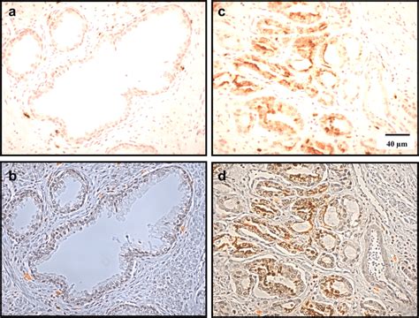 Immunostaining Of Human Prostate Tissues For Vgsc Expression