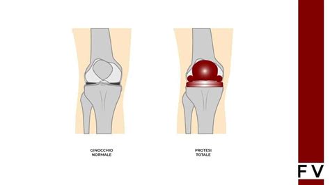 Protesi Ginocchio Indicazioni Intervento Durata E Tempi Di Recupero