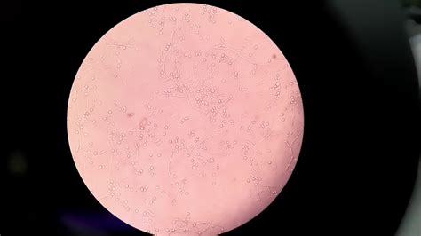 Malassezia Colony On Sda And Its Microscopy Showing Yeast Cells And Short Hyphae Youtube