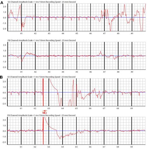 Rhythm Strip From Wearable Cardiac Defibrillator Interrogation Showing Download Scientific