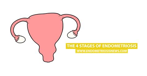 The 4 Stages of Endometriosis - Endometriosis News