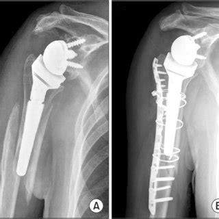 A 59-year-old patient had an acromial stress fracture (arrow) six... | Download Scientific Diagram