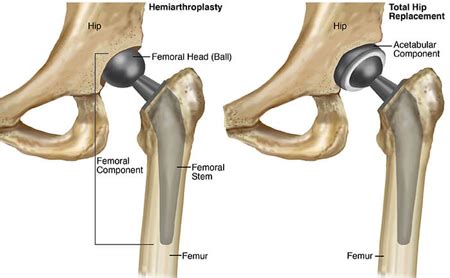 Total Hip Joint Replacement Surgery Dr Manoj Mishra Orthopedic Doctor