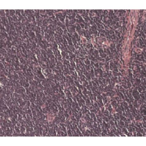 The Lymphoma Histological Image Samples For Different NHL Subtypes A