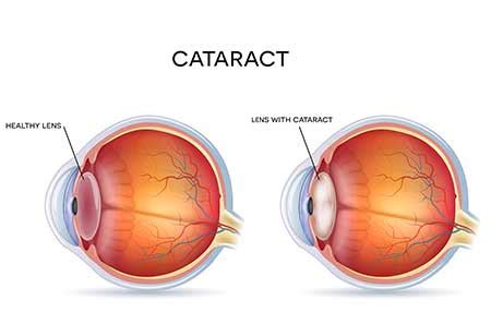 Cataract Surgery - Dr Lynn Yeo | Experienced Eye Surgeon, Singapore