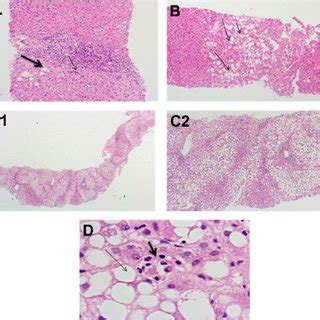 Steatosis assessment in liver histopathology. ( A ) Liver case with a... | Download Scientific ...