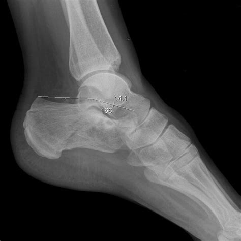 Calcaneal fracture - DocCheck