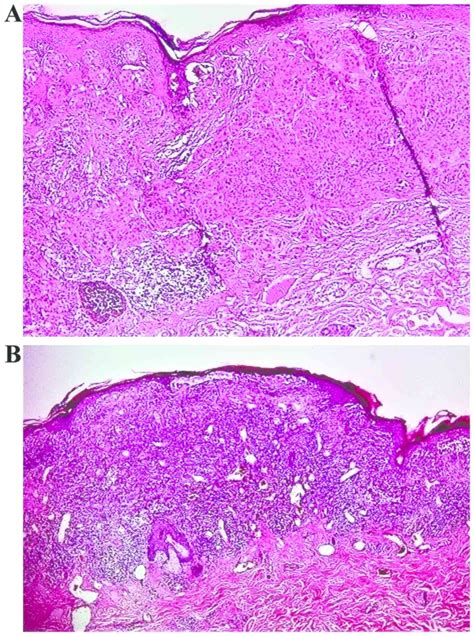 Tumor Infiltrating Lymphocytes The Regulator Of Melanoma Evolution