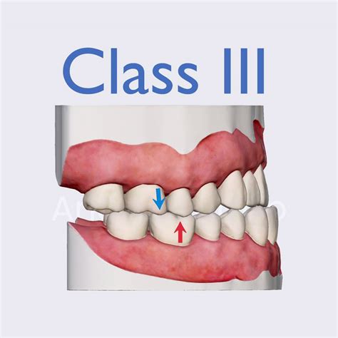 Angles Classification Class Iii Anatomyapp