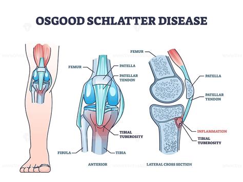 Osgood schlatter disease condition with knee joint pain outline diagram - VectorMine