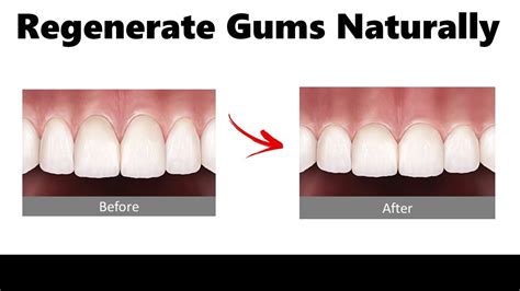 Gum Tissue Regeneration How To Regenerate Gums Naturally YouTube