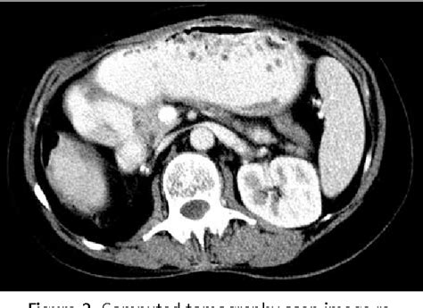 Figure 1 From Duodenal Obstruction Due To Annular Pancreas Associated With Carcinoma Of The