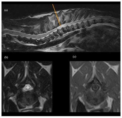 Mri Of The Cervicothoracic Spinal Cord A Sagittal Plane Of