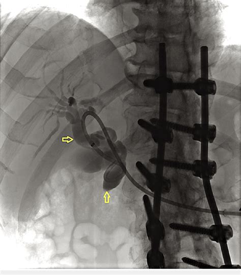 Retrograde Cholangiopancreatography Showing A Tortuously Dilated Common