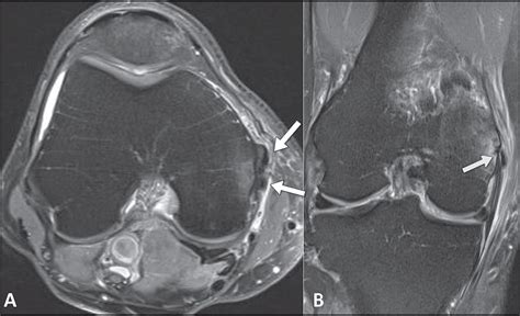 Scielo Brasil Imaging Findings Of Acute Calcific Periarthritis