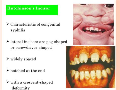 Developmental Disturbances Of The Teeth