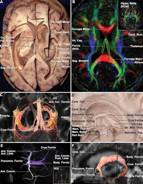 Fornix Neuroanatomy The Neurosurgical Atlas