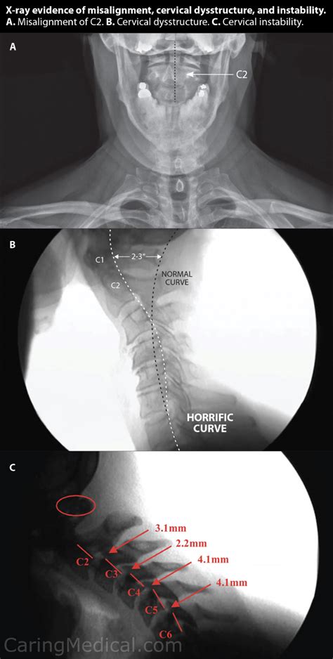 Vagus Nerve Compression In The Neck Symptoms And Treatments