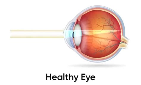 Hyperopia Farsightedness Causes Symptoms And Treatment Browser Scene