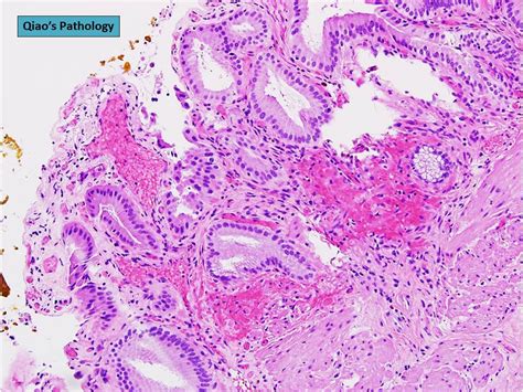 Qiao S Pathology Angiodysplasia Of The Gallbladder A Photo On Flickriver