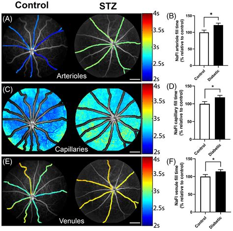 Anomalies In Neurovascular Coupling During Early Diabetes A Review