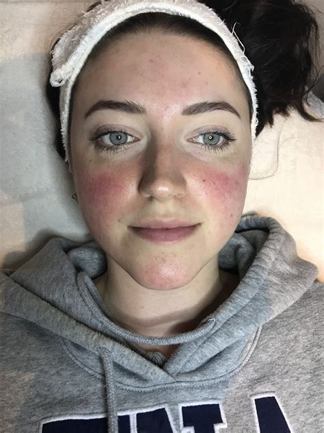 Ipl For Rosacea At Home Knobledshift