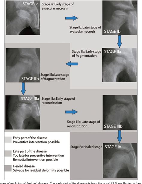 Stages Of Legg Calve Perthes Disease