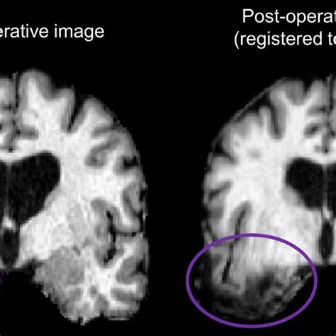 (PDF) Remote effects of temporal lobe epilepsy surgery: long-term ...