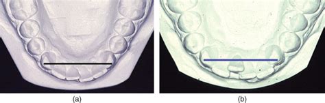 Retention And Post Retention Outcome Pocket Dentistry