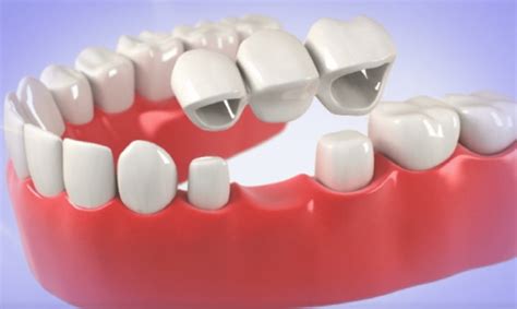 Diş Köprüsü Nedir Konya Diş Köprüsü Tedavisi Dentium Meram