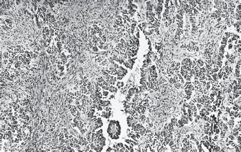 Retiform Sertoli Leydig Cell Tumor With Elongated Tubules And Papillae